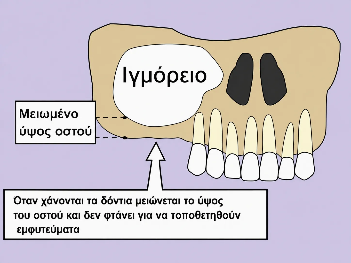 Το ύψος του οστού έχει μειωθεί μετά την απώλεια δοντιών