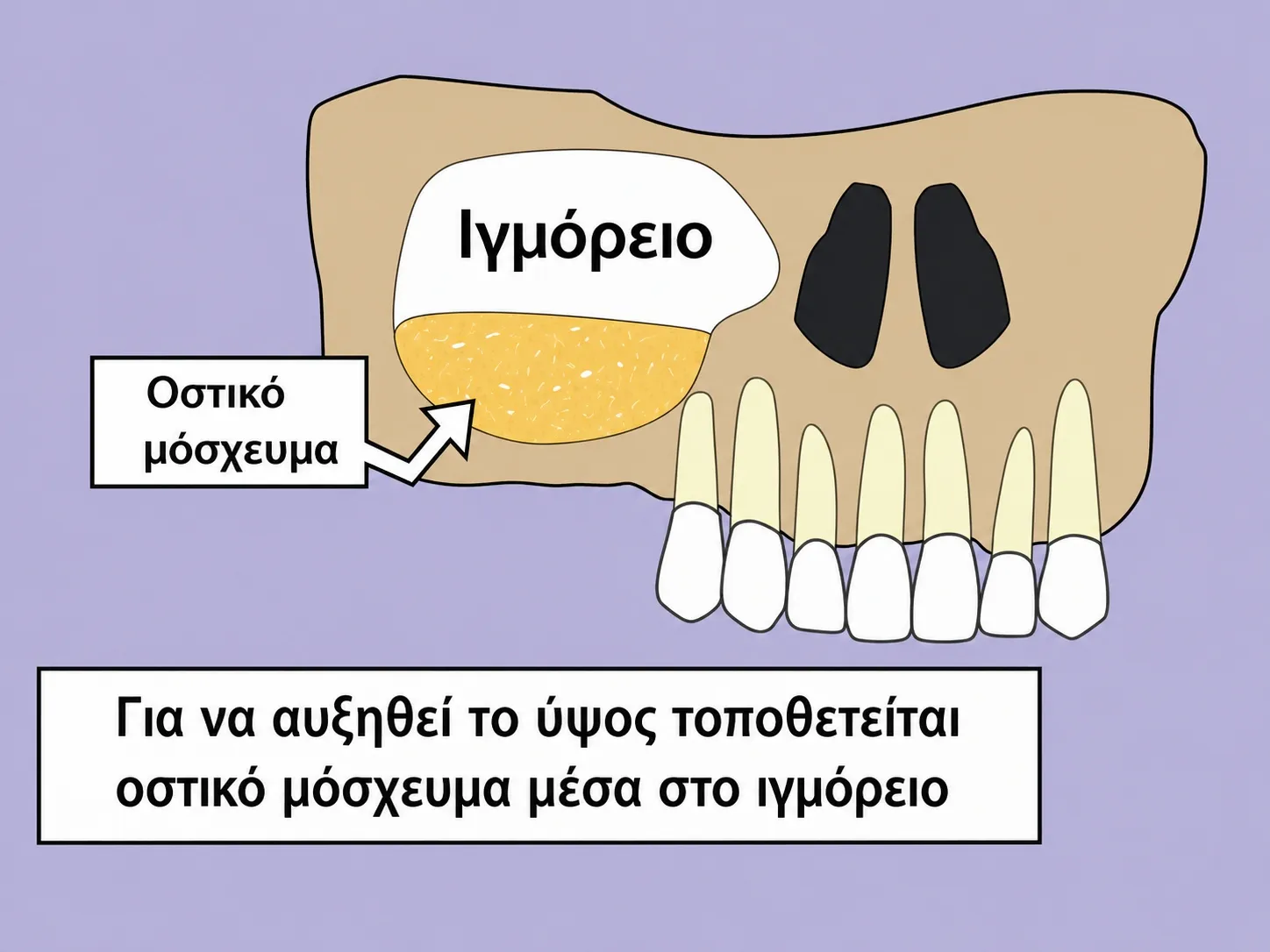 Τοποθέτηση μοσχεύματος