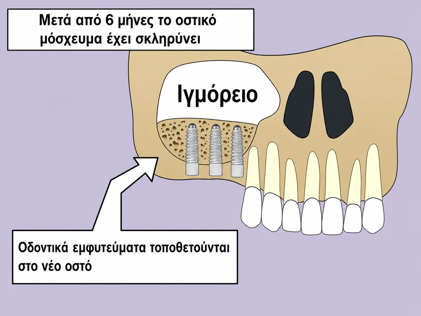 Το ύψος του οστού είναι αρκετό για την τοποθέτηση εμφυτευμάτων