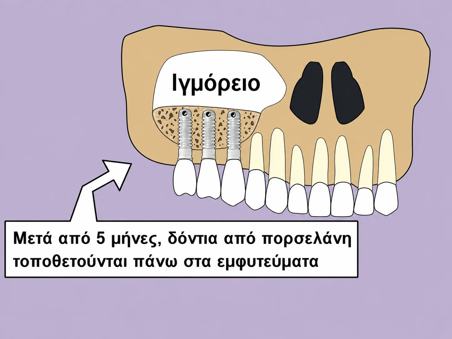 Η τελική εικόνα με τις στεφάνες στο στόμα